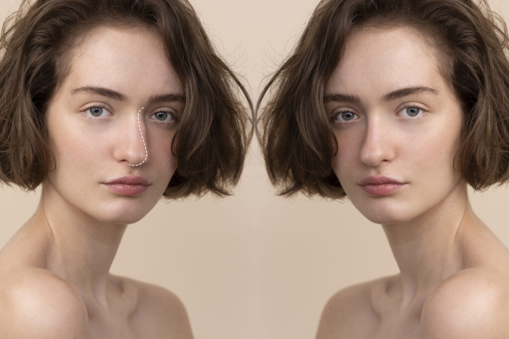 How to Fix a Crooked Nose: Surgical & Non-Surgical Treatment 2 How to Fix a Crooked Nose: Surgical & Non-Surgical Treatment