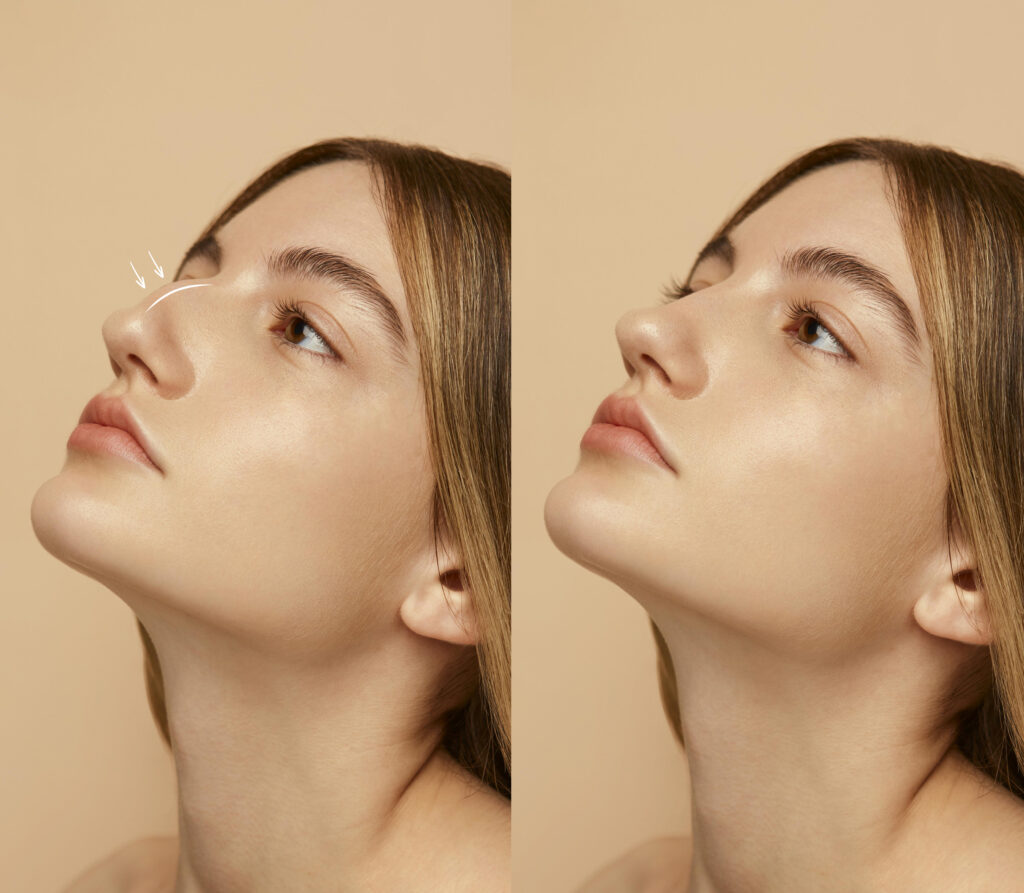 How to Fix a Crooked Nose: Surgical & Non-Surgical Treatment 3 How to Fix a Crooked Nose: Surgical & Non-Surgical Treatment