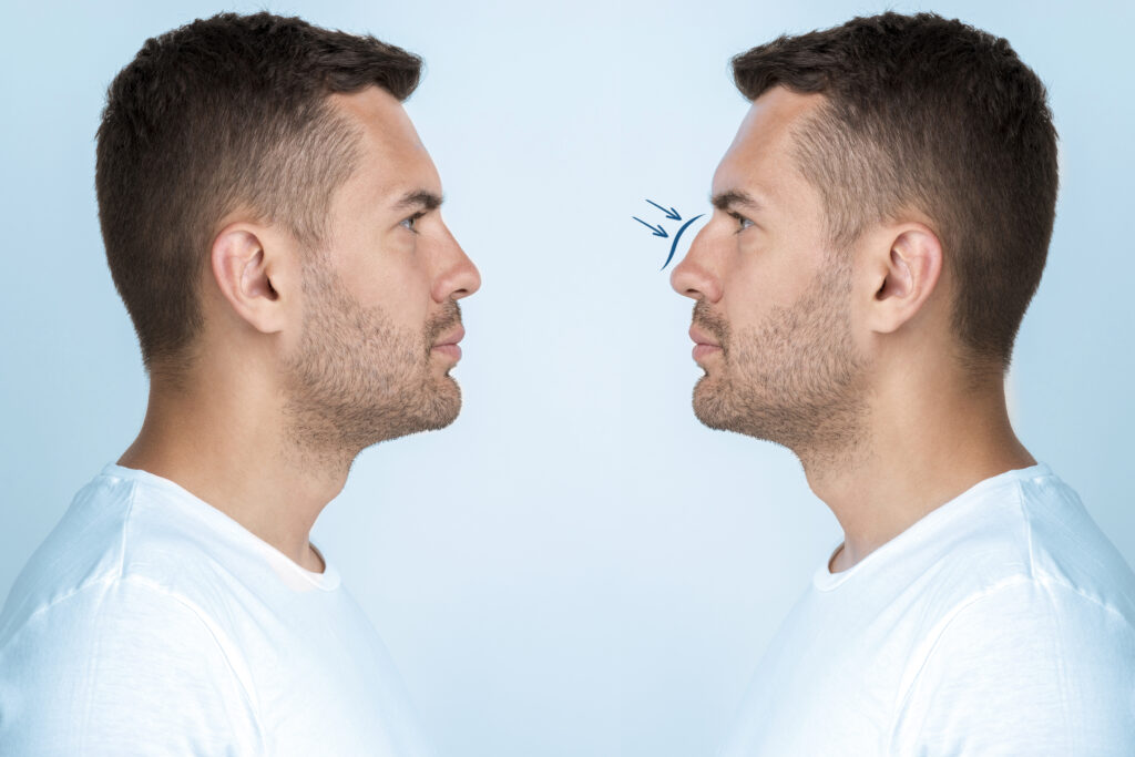 Revision Rhinoplasty: A Complete Guide 2 Revision Rhinoplasty: A Complete Guide