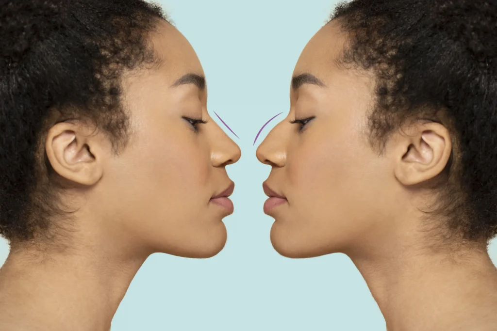 best rhinoplasty surgeons in turkey