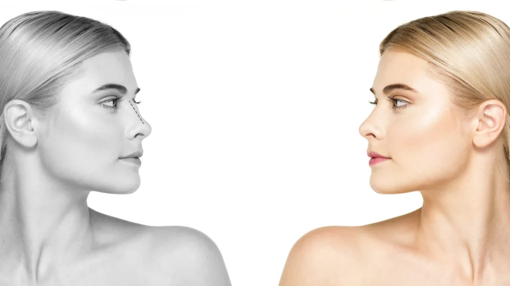 closed rhinoplasty in turkey
