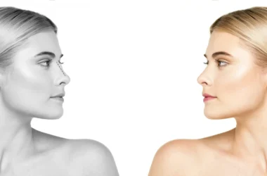 closed rhinoplasty in turkey