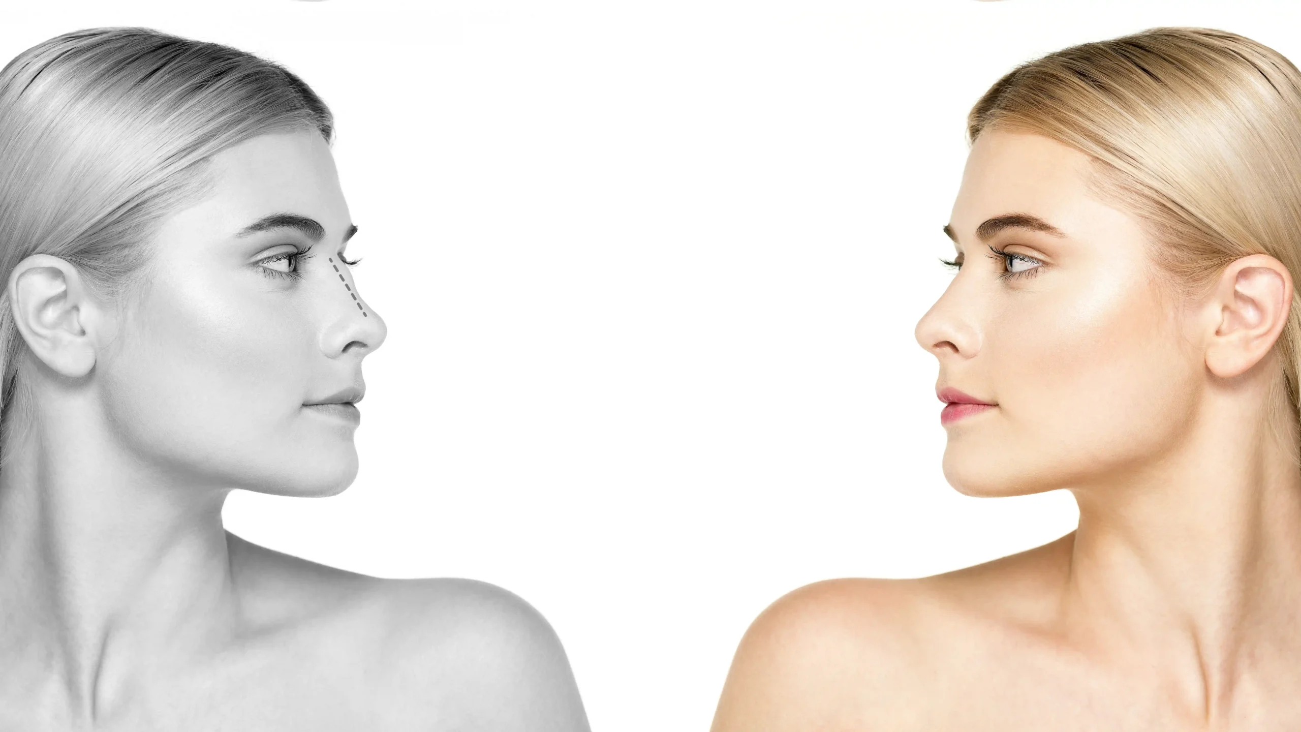 closed rhinoplasty in turkey