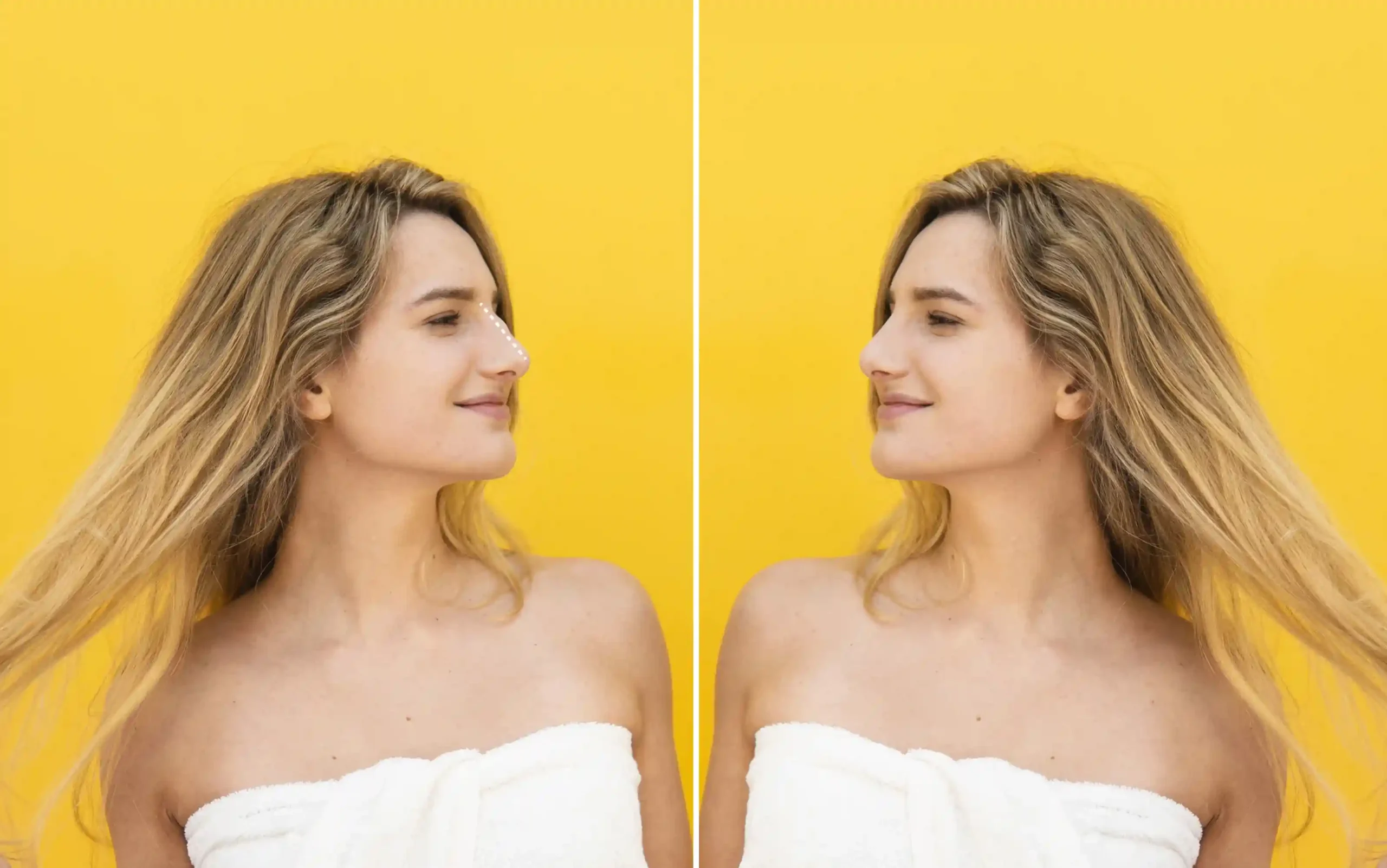 best time for rhinoplasty in turkey