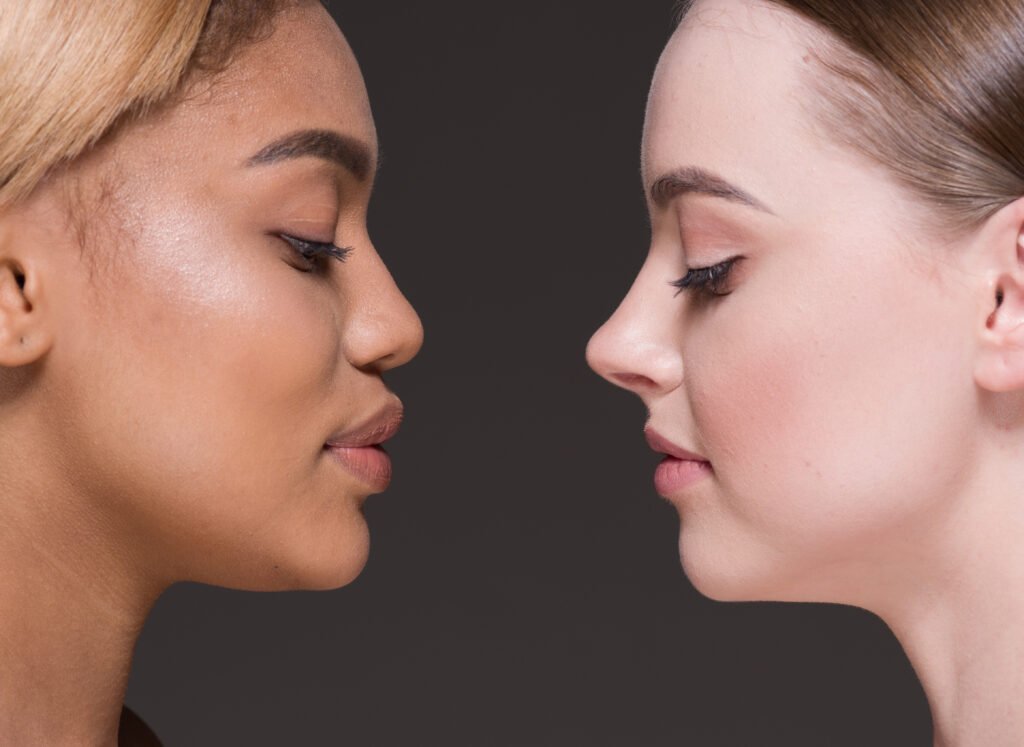 Revision Rhinoplasty in Istanbul, Turkey 2 Revision Rhinoplasty in Istanbul, Turkey