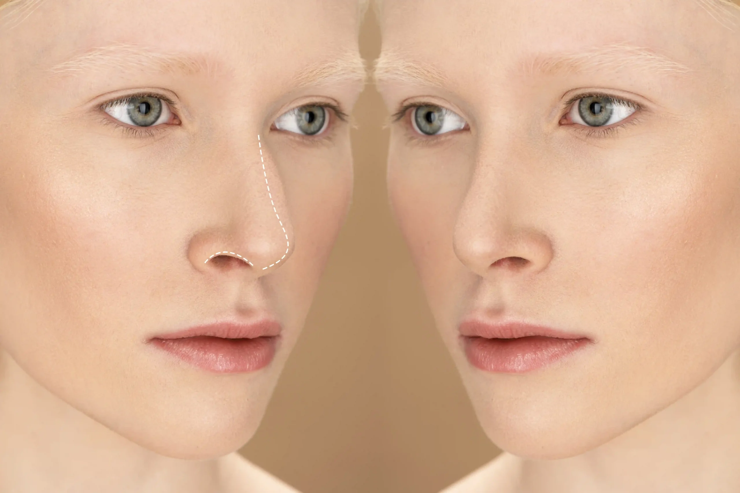 non surgical nose job in turkey vs surgical